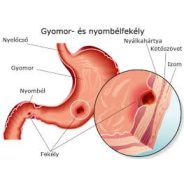 Gyomor- vagy nyombélfekély