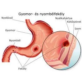 Gyomor- vagy nyombélfekély