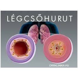 Hurut, hurutos köhögés, légcsőhurut