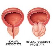 Prosztata, prosztata megbetegedések